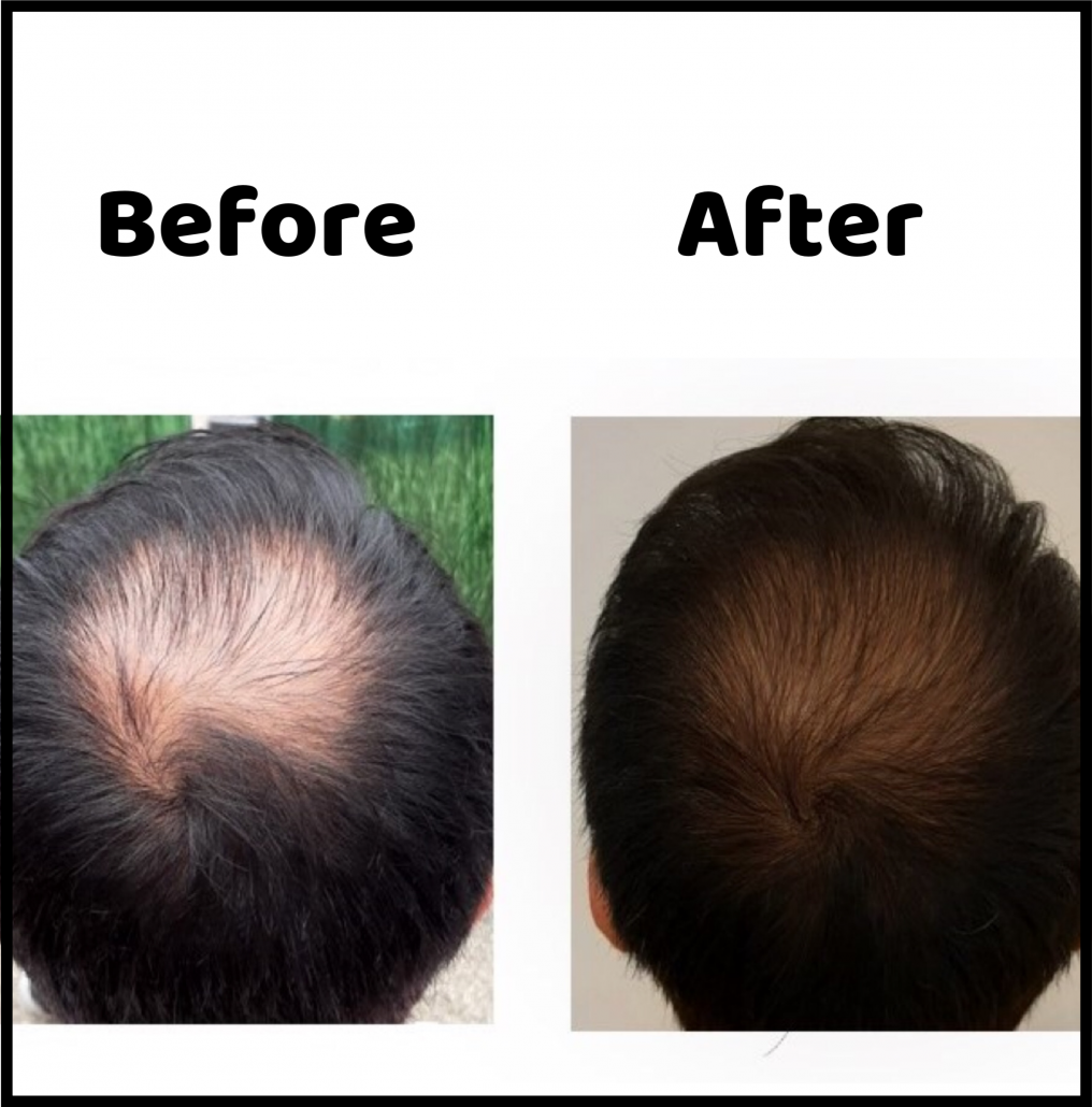 Good results on Google SERP when searching for 'hair loss before after images'