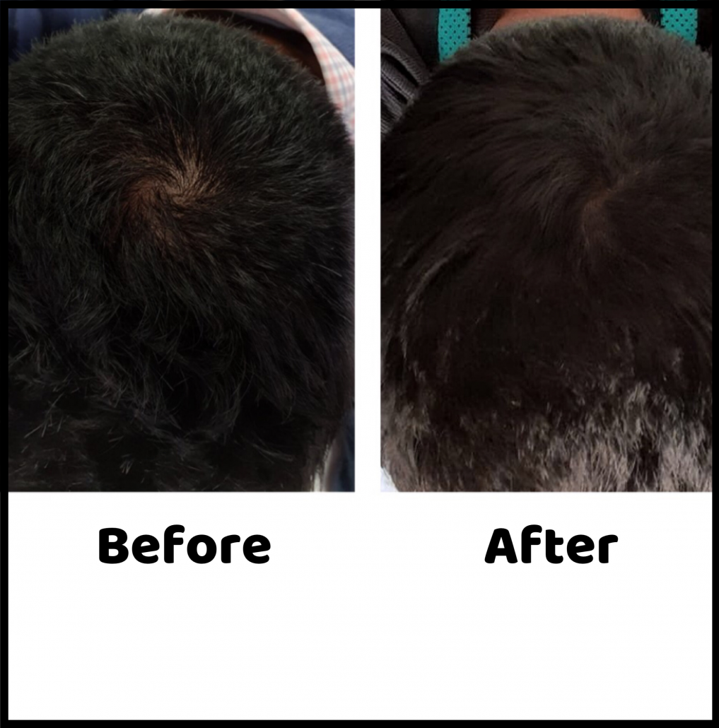 Good results on Google SERP when searching for 'hair loss before after images'