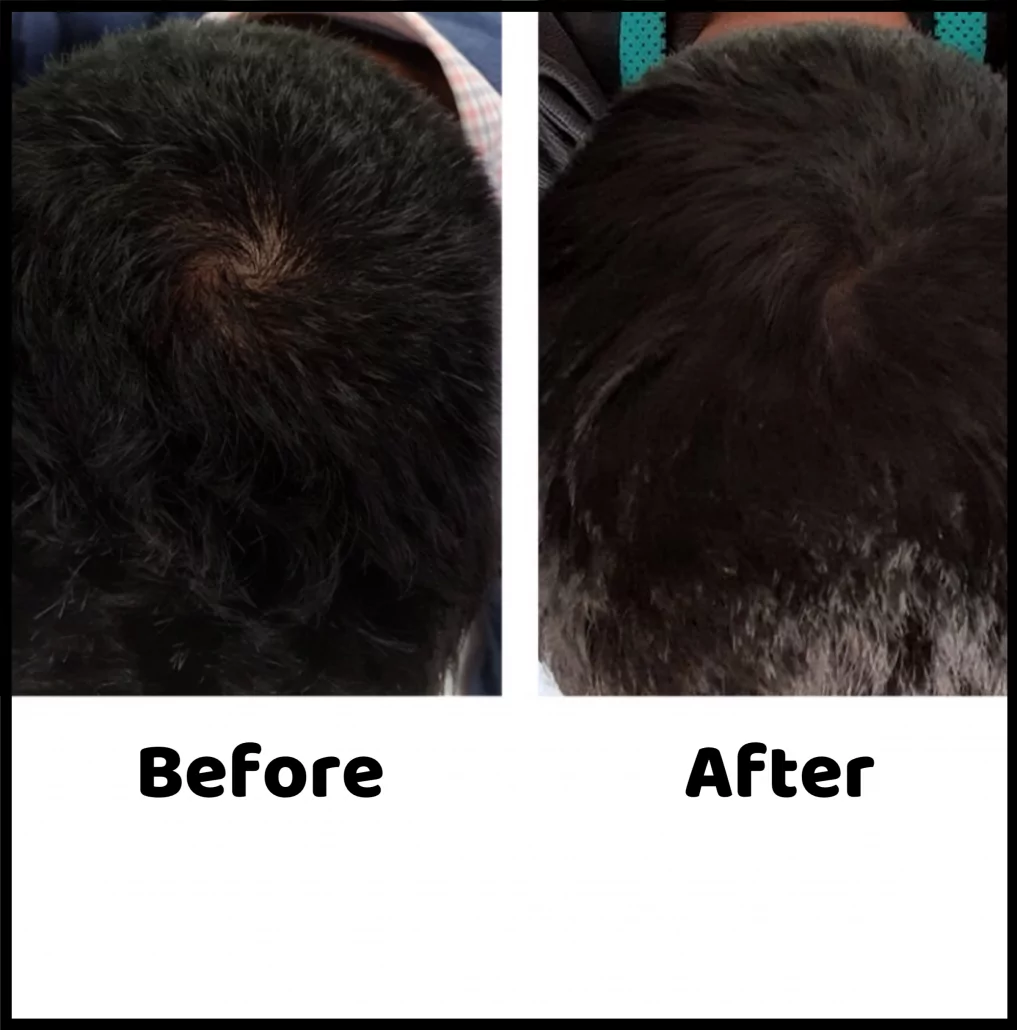 Good results on Google SERP when searching for 'hair loss before after images'